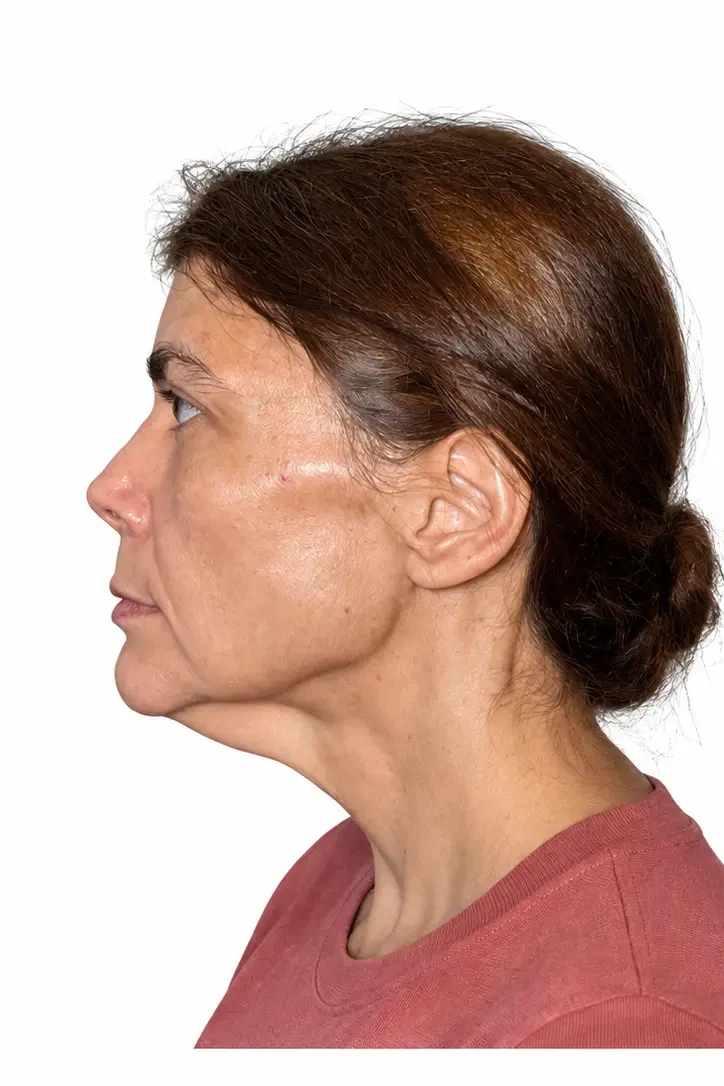 Before facial rejuvenation