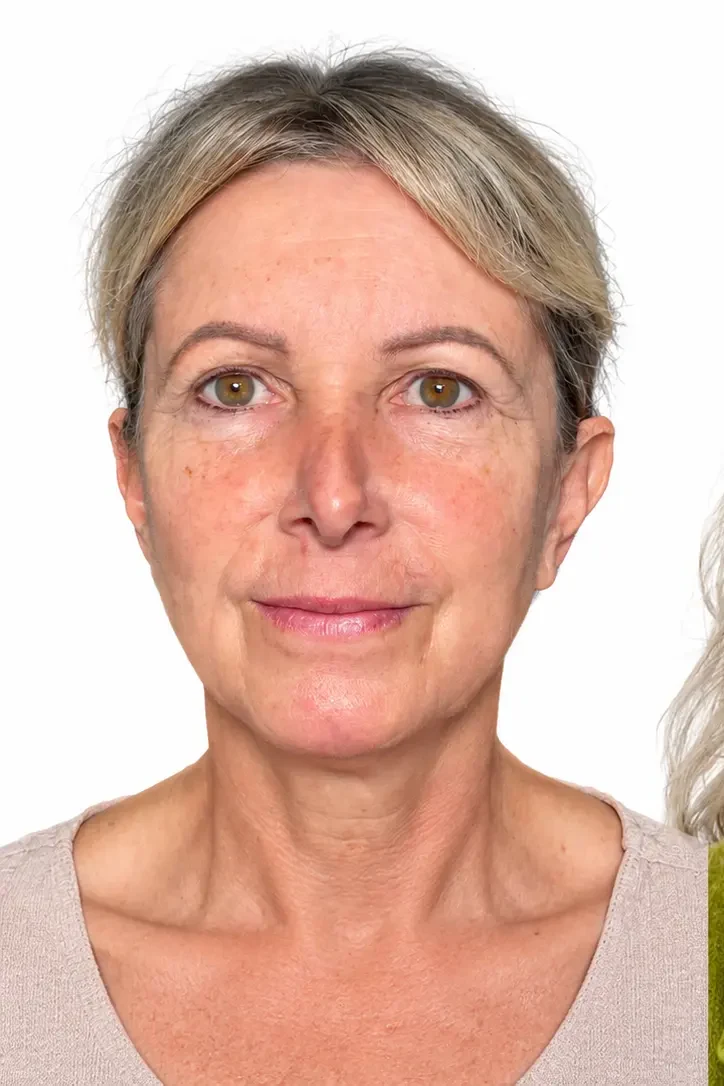 Before facial rejuvenation