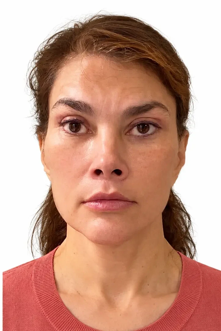 After facial rejuvenation