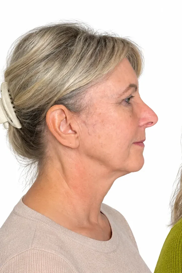 Before facial rejuvenation