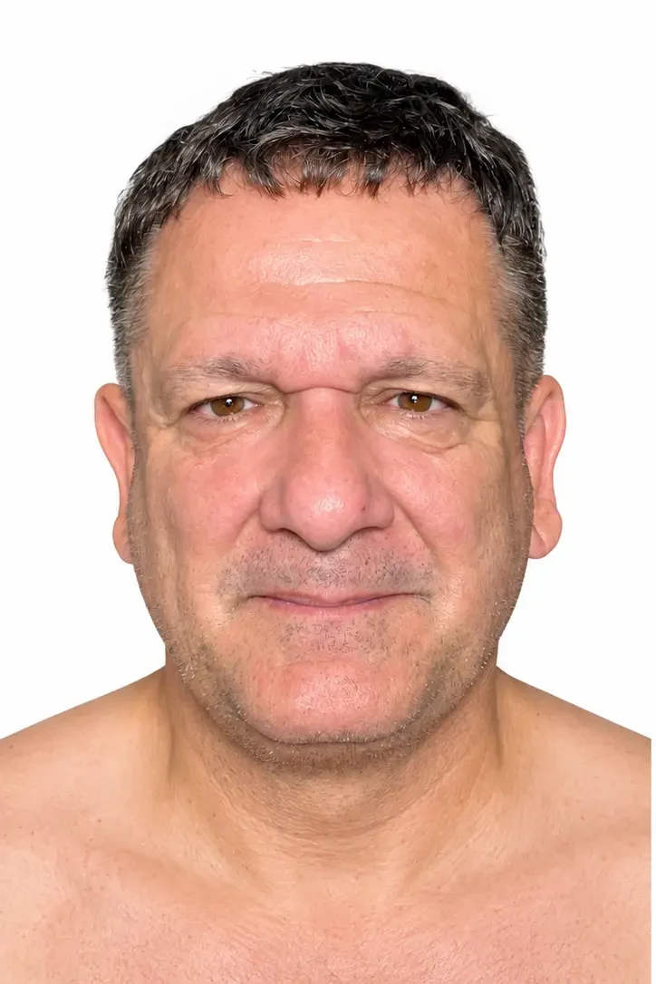 Before facial rejuvenation