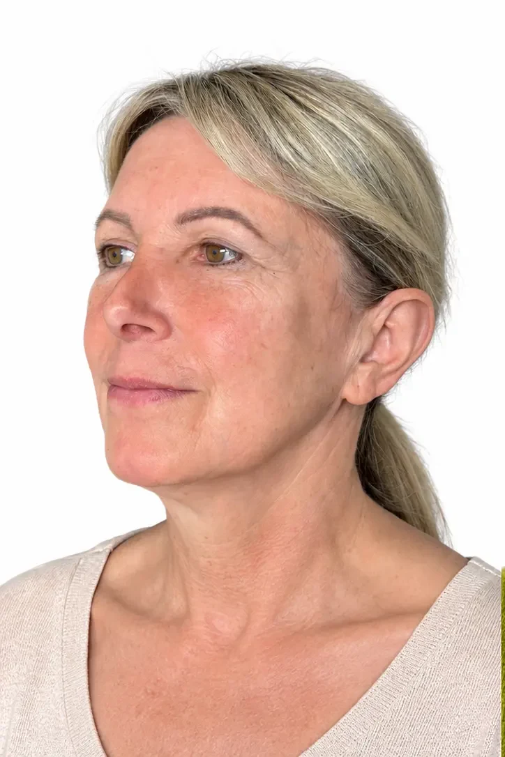 Before facial rejuvenation