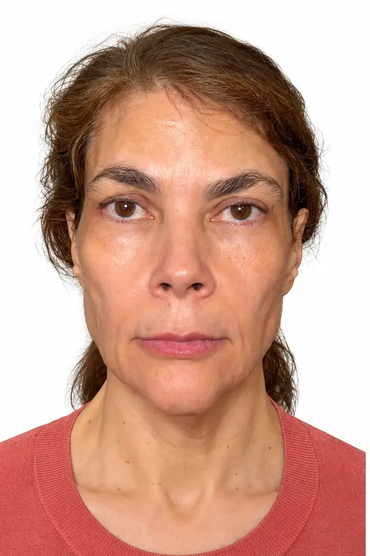 Before facial rejuvenation