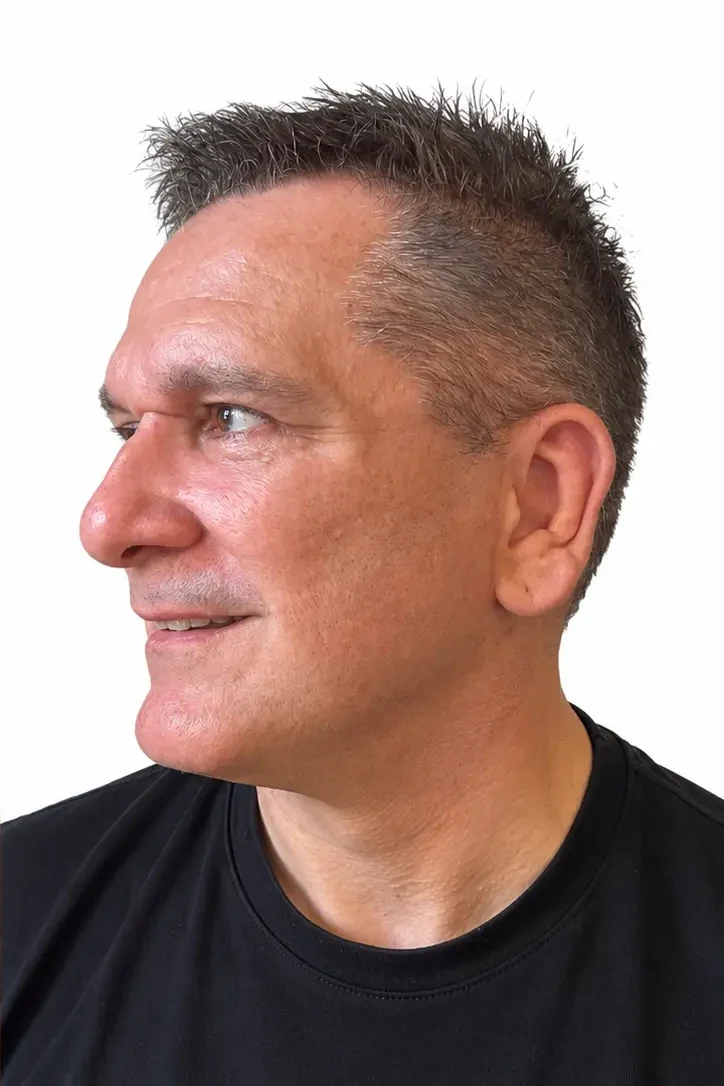 After facial rejuvenation