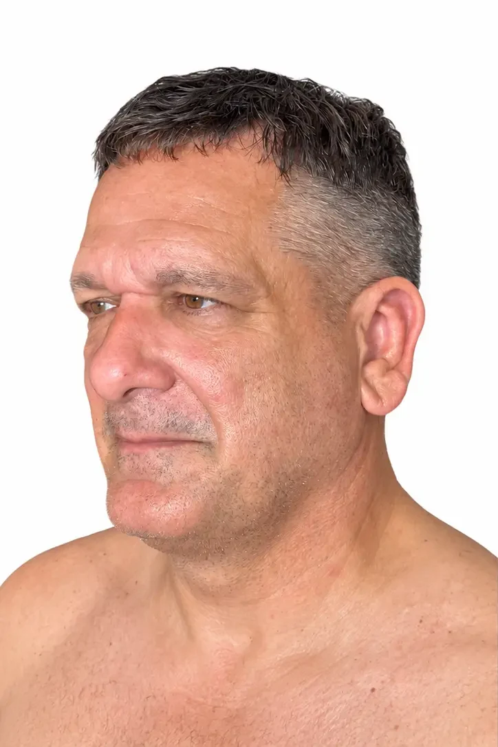 Before facial rejuvenation