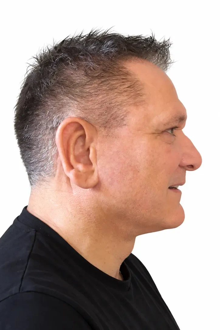 After facial rejuvenation