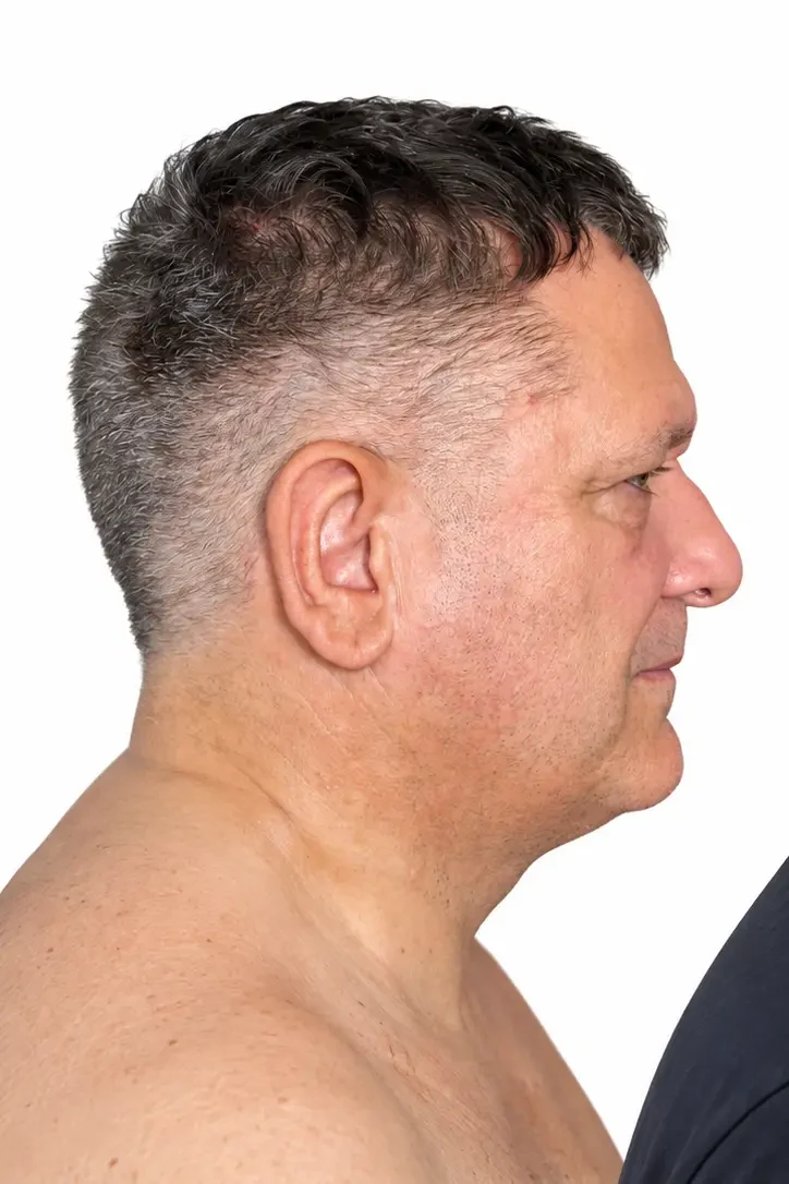 Before facial rejuvenation